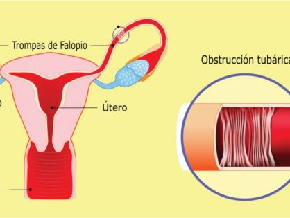 Obstrucción Tubárica